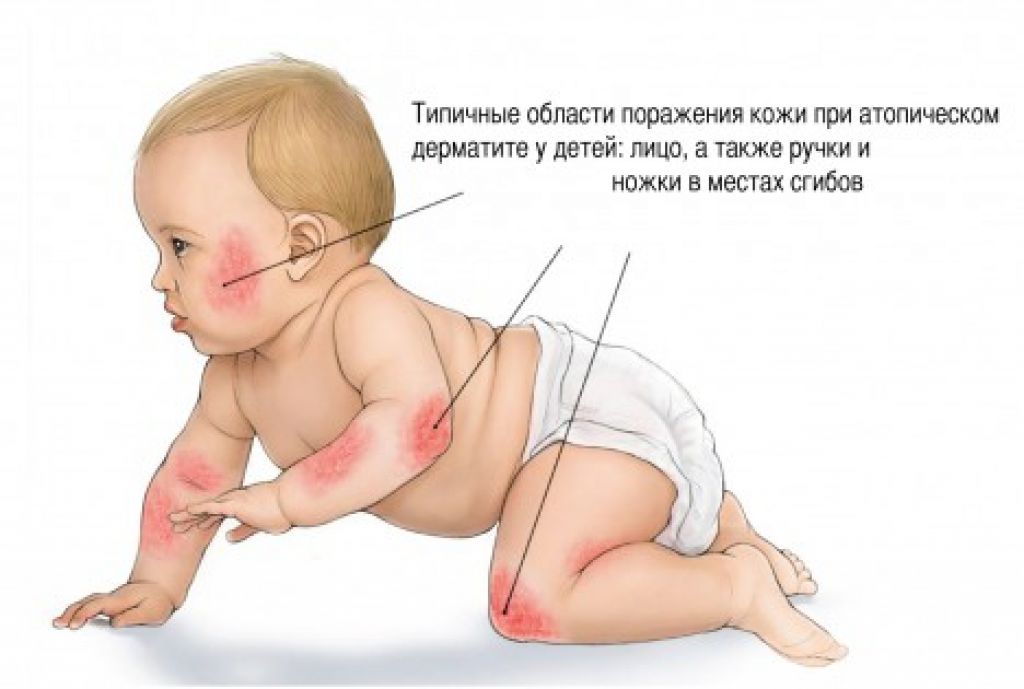 Картинки детской формы атопического дерматита
