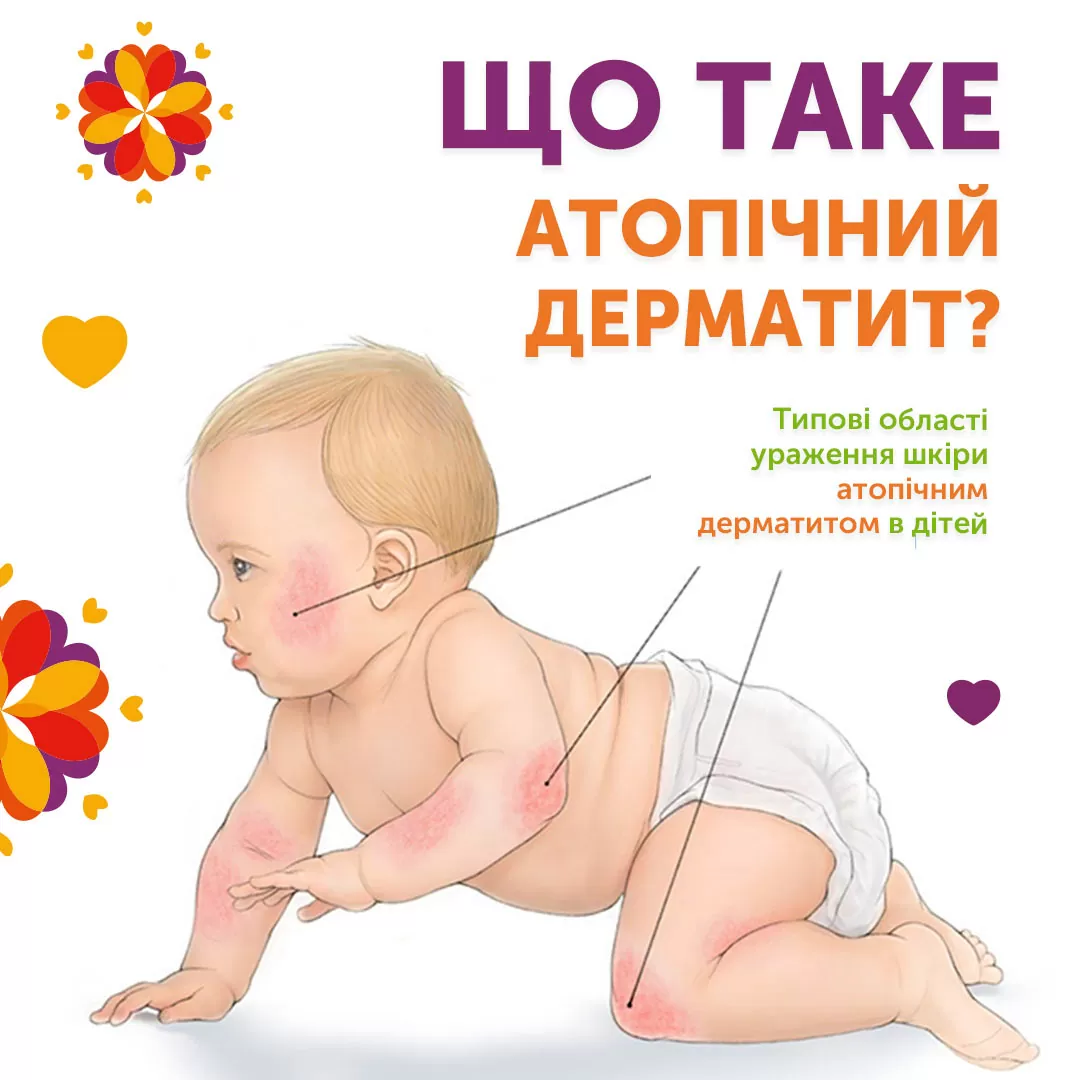 Изображения атопического дерматита у младенцев