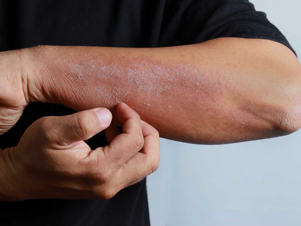 Фотографии последствий атопического дерматита на коже