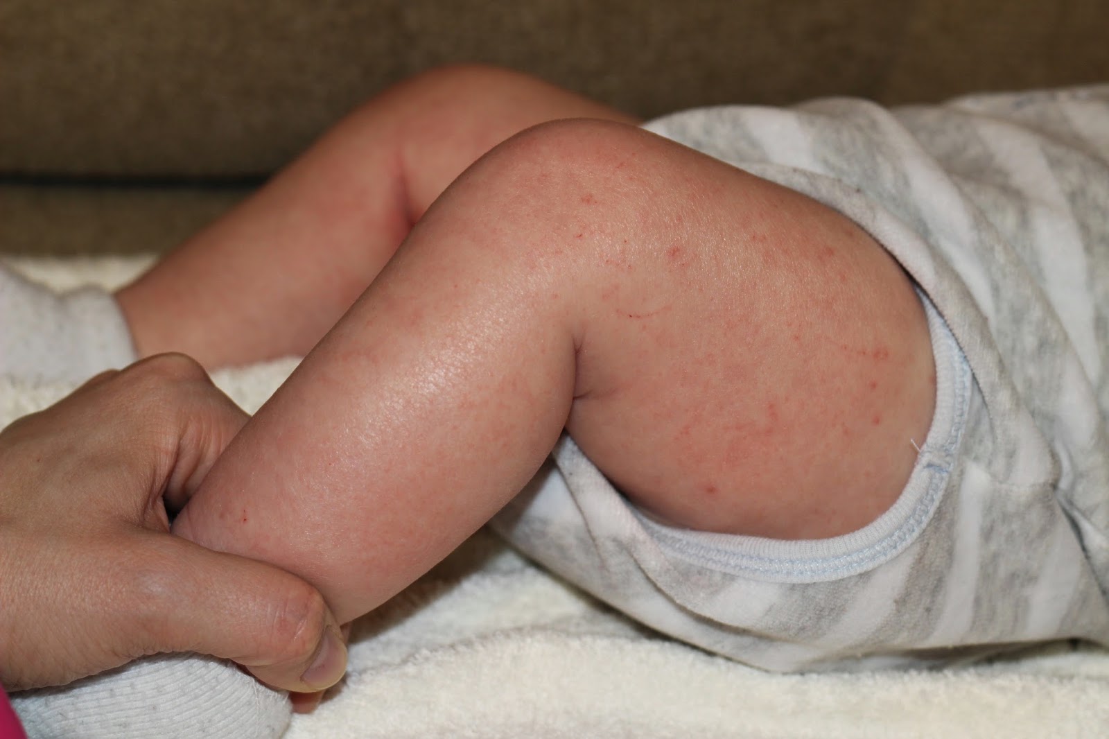 Фото атопического дерматита в кожных складках
