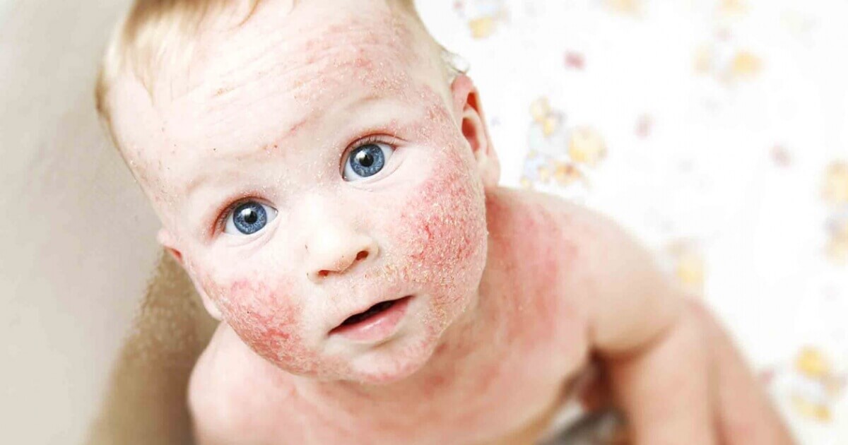 Изображения сыпи на лице при атопическом дерматите