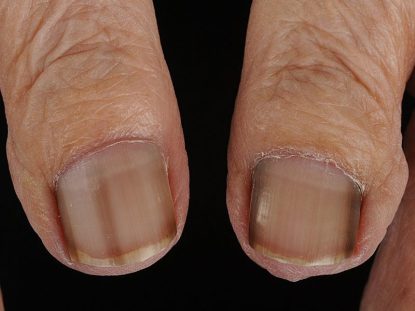 Основы болезней ногтей на руках