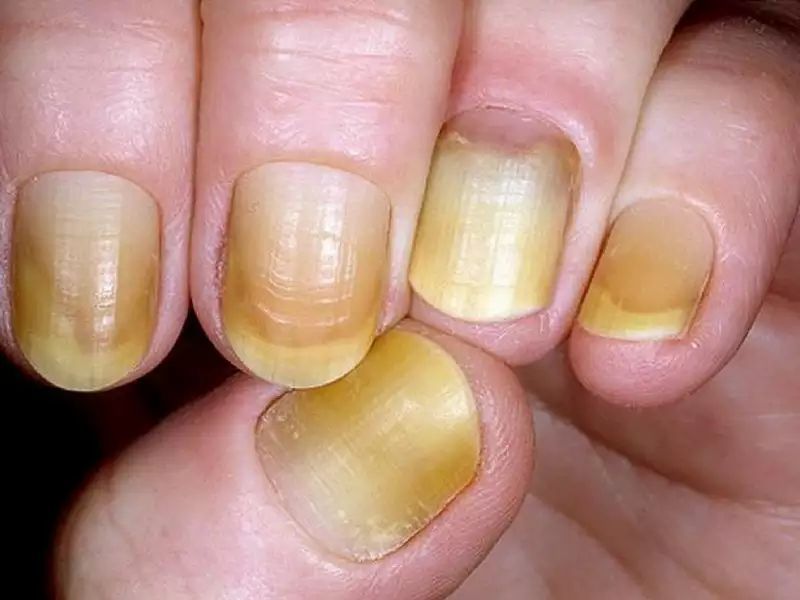 Диагностика и лечение болезней ногтей на руках