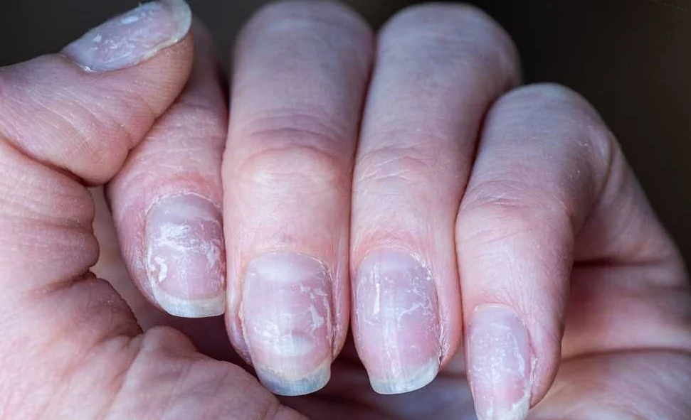 Здоровье ногтей на руках: основные проблемы и решения