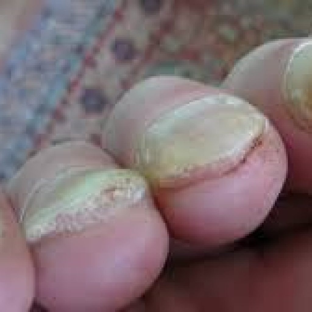 Основные симптомы и причины болезней ногтей на руках