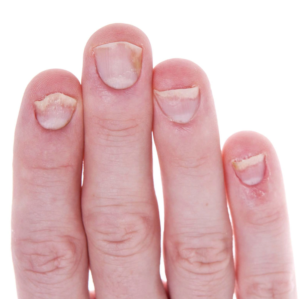 Болезни ногтей на руках: больше фотографий и симптомов