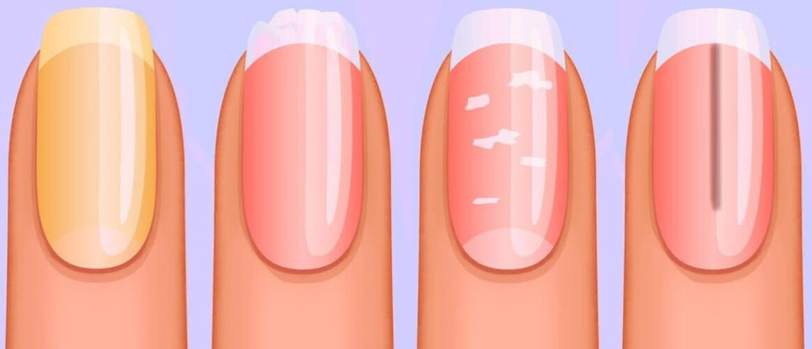 Болезни ногтей на руках: 5 причин и их лечение