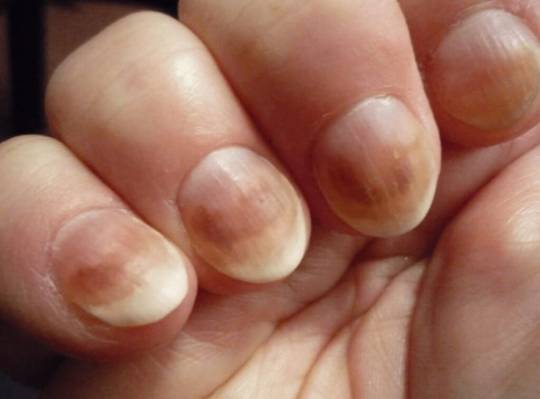 Болезни ногтей на руках: фотографии и рекомендации врача