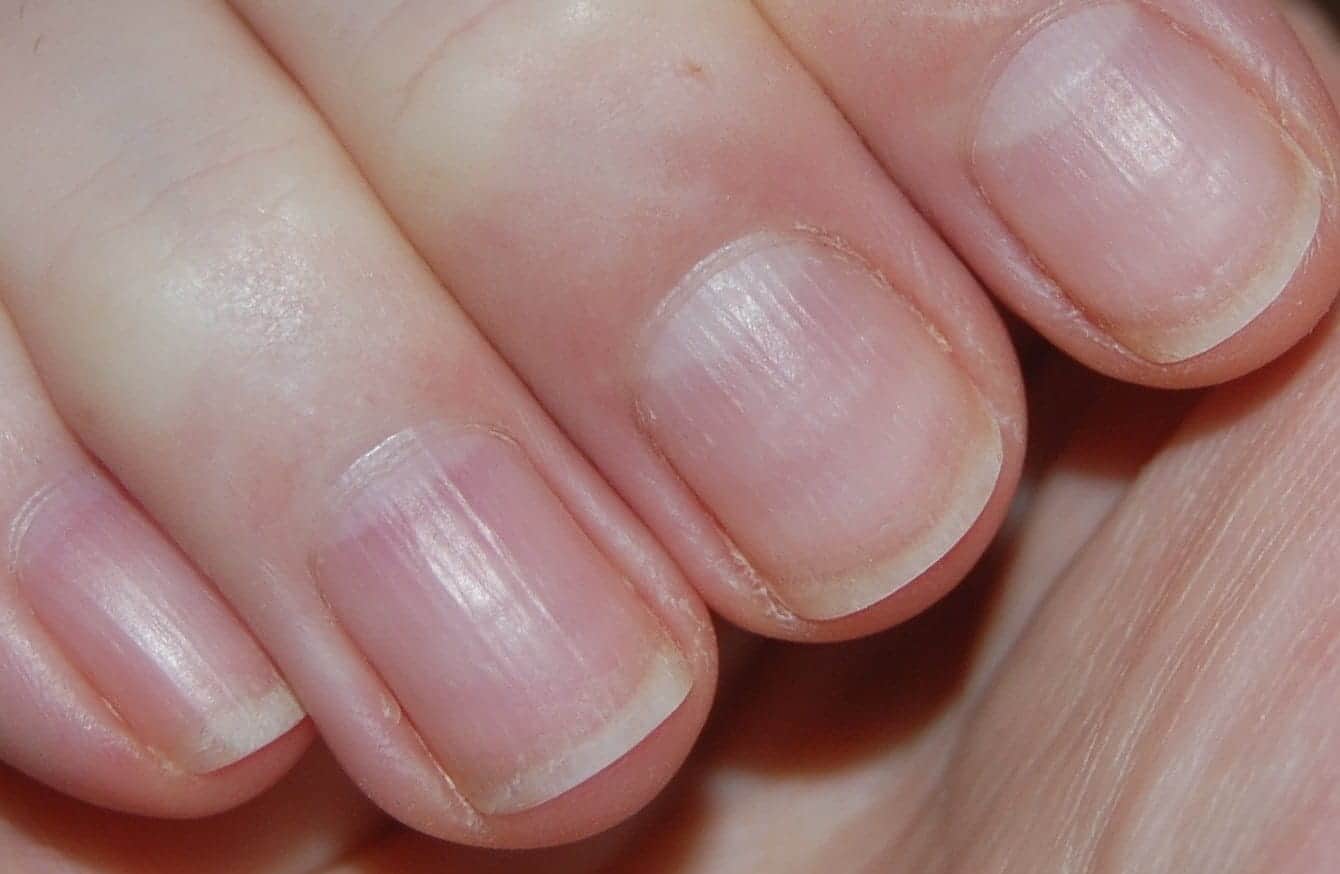 Болезни ногтей на руках: 10 фото эффективных лечебных методов