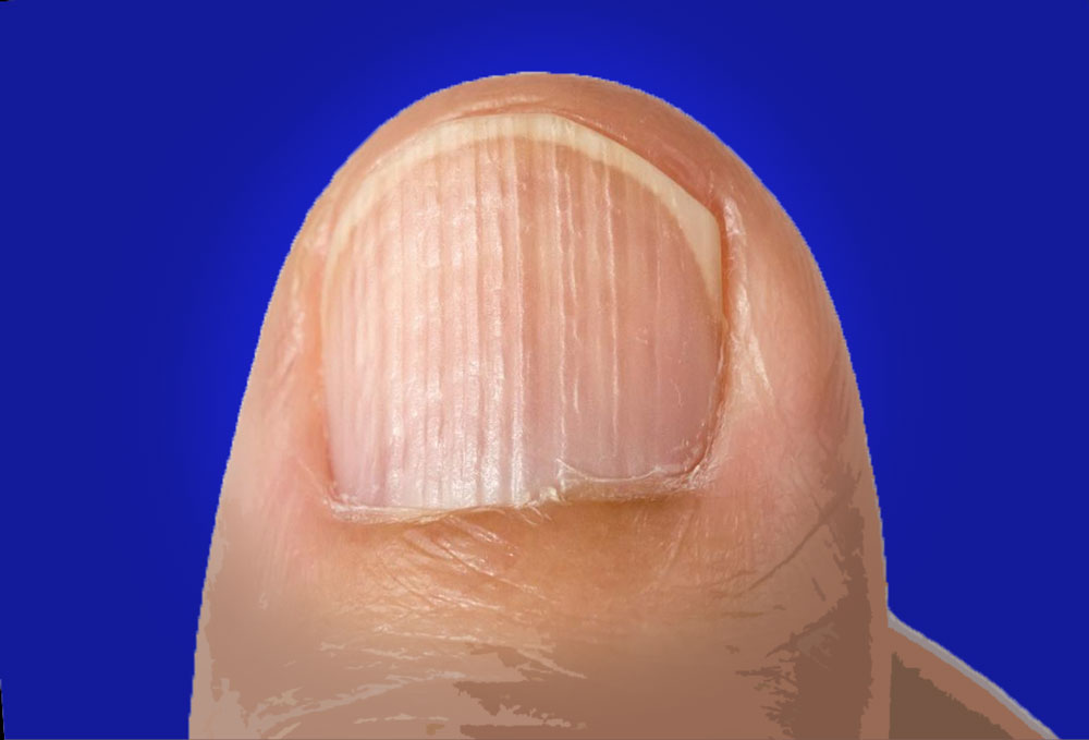 Болезни ногтей на руках: картинки и рекомендации по профилактике