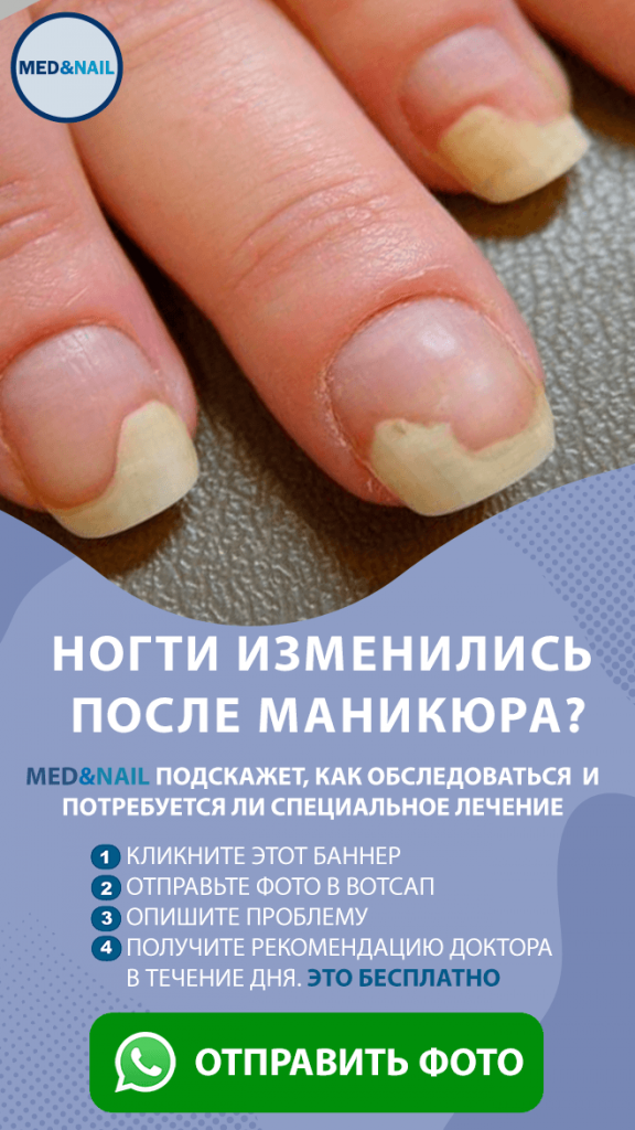 Привычки, которые могут навредить здоровью ногтей на руках: изображения и советы