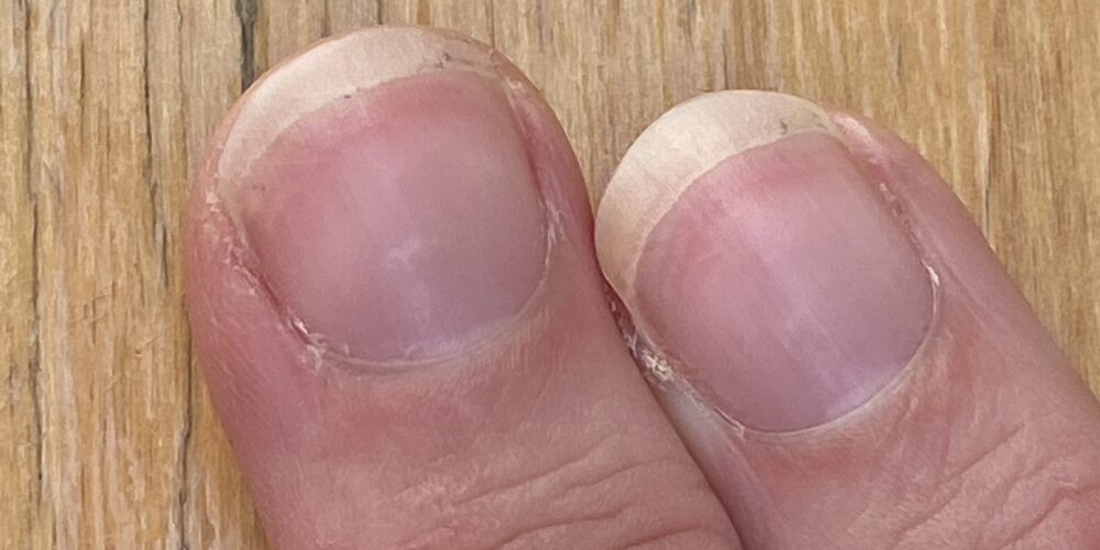 Фотографии болезней ногтей на руках и их причины