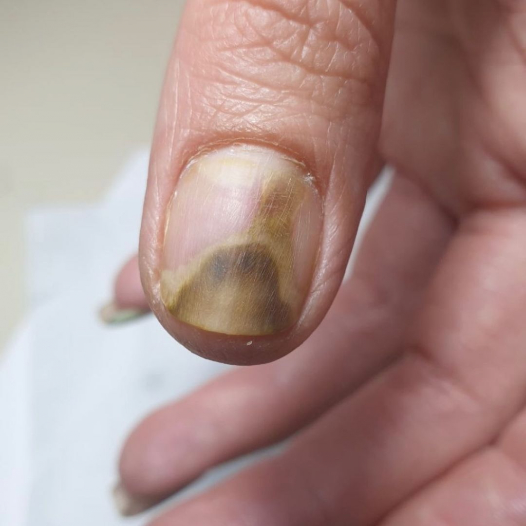 Болезнь ногтей на руках: изображения и симптомы