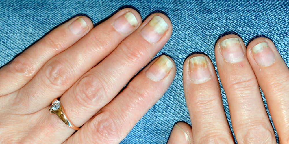 Болезни ногтей на руках: подробные фото